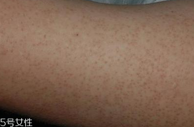 腿上有雞皮膚怎么辦 腿上雞皮膚怎么消除 腿上有雞皮膚怎么辦 腿上雞皮膚怎么消除