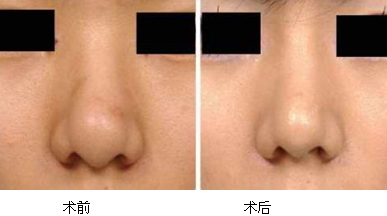縮鼻手術(shù)多久恢復(fù)？縮鼻手術(shù)傷口才會好