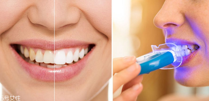 牙齒美白能保持多久？牙齒美白方法有哪些？