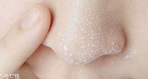 黑頭不管它會變大嗎？黑頭不管它會怎樣？