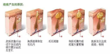 頑固痘痘怎么消除？油皮為什么反復(fù)爆痘？