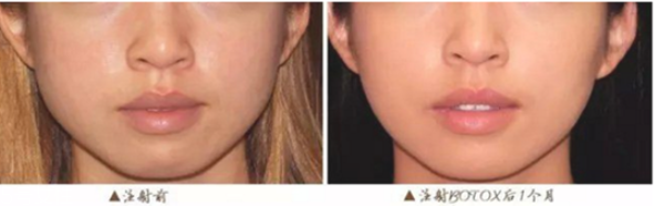 瘦臉針副作用多久出現(xiàn) 瘦臉針的過(guò)程 瘦臉針副作用多久出現(xiàn) 瘦臉針的過(guò)程