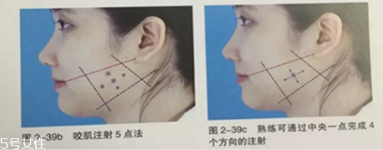 瘦臉針副作用多久出現(xiàn) 瘦臉針的過(guò)程 瘦臉針副作用多久出現(xiàn) 瘦臉針的過(guò)程