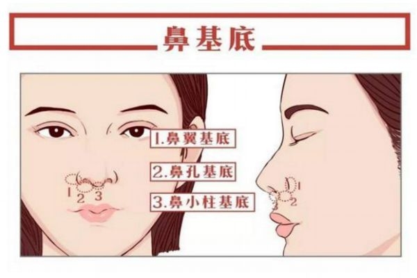 鼻基底填充是什么 關于鼻基底填充