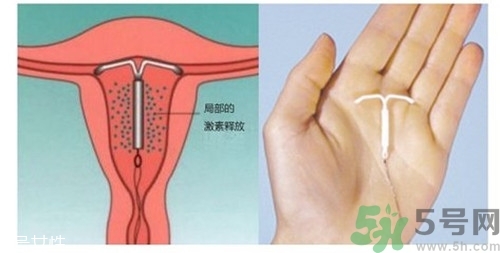 上環(huán)是什么意思？上環(huán)后注意事項(xiàng)有哪些？