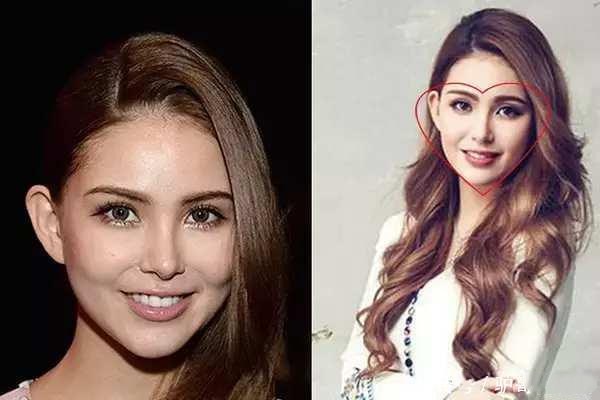 豐蘋(píng)果肌的方法有哪些 哪些人適合填充蘋(píng)果肌 豐蘋(píng)果肌的方法有哪些 哪些人適合填充蘋(píng)果肌