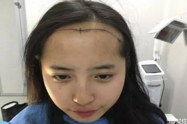 額頭太大怎么辦呢 為什么有的人額頭比較大呢 額頭太大怎么辦呢 為什么有的人額頭比較大呢