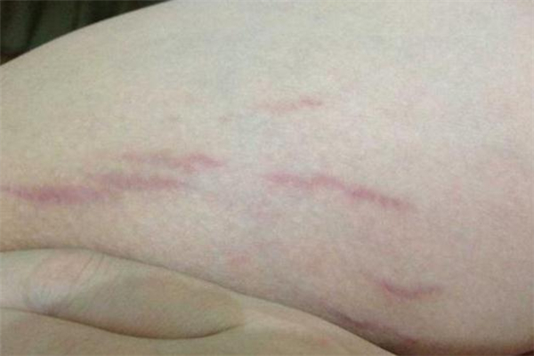 肥胖紋是什么顏色 紅色肥胖紋怎么去除 肥胖紋是什么顏色 紅色肥胖紋怎么去除