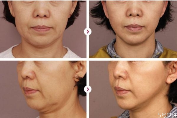 熱瑪吉怎樣是什么 熱瑪吉適應(yīng)人群 熱瑪吉怎樣是什么 熱瑪吉適應(yīng)人群