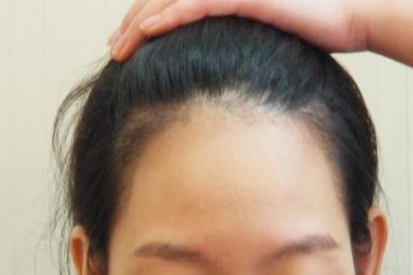 怎么樣讓發(fā)際線(xiàn)變低 如何讓發(fā)際線(xiàn)前移