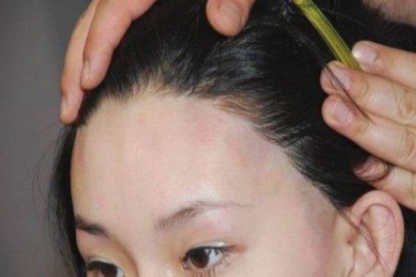 怎么樣讓發(fā)際線(xiàn)變低 如何讓發(fā)際線(xiàn)前移