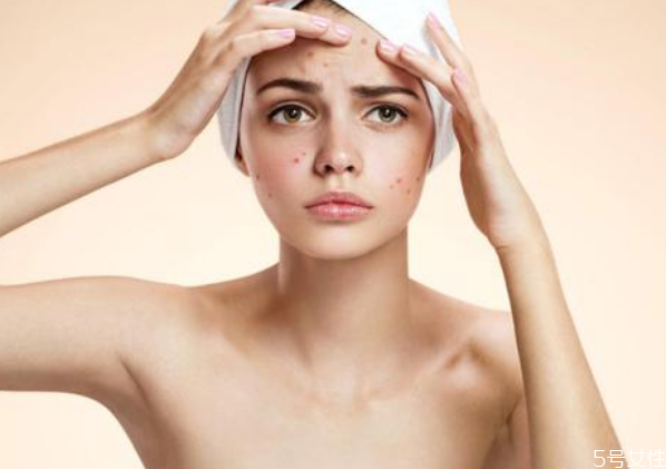 戴口罩下巴長痘痘怎么辦 怎樣避免戴口罩悶痘 戴口罩下巴長痘痘怎么辦 怎樣避免戴口罩悶痘