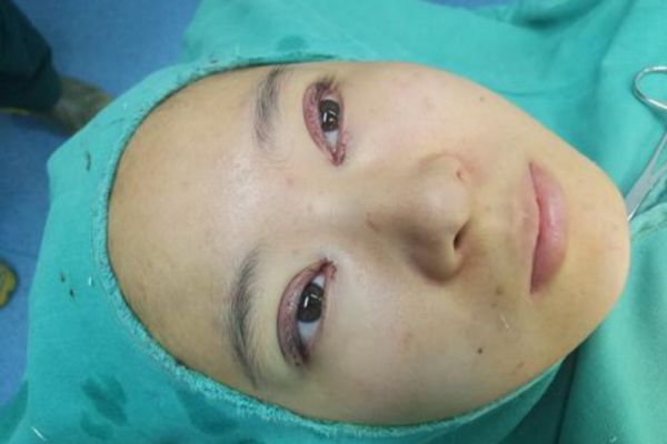 腫眼泡可以割雙眼皮嗎 腫眼泡能割雙眼皮嗎 腫眼泡可以割雙眼皮嗎 腫眼泡能割雙眼皮嗎