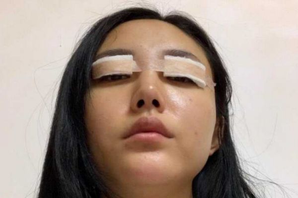 腫眼泡可以割雙眼皮嗎 腫眼泡能割雙眼皮嗎 腫眼泡可以割雙眼皮嗎 腫眼泡能割雙眼皮嗎
