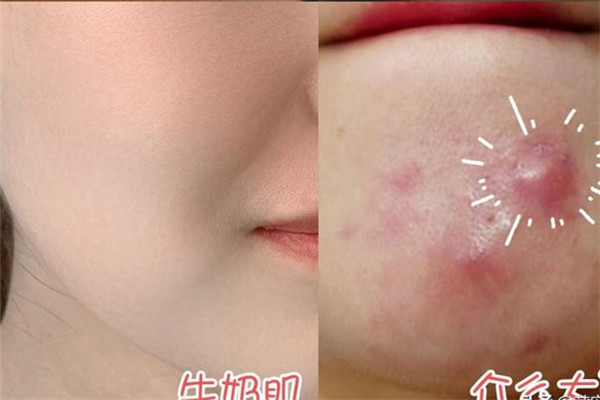 我的皮膚老是長痘痘是什么原因呢 我的皮膚老是長痘痘是什么原因呢