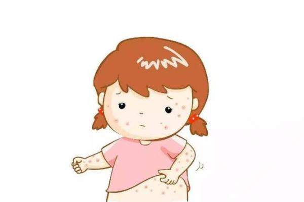 蕁麻疹可以洗熱水澡嗎 蕁麻疹可以徹底治愈嗎 蕁麻疹可以洗熱水澡嗎 蕁麻疹可以徹底治愈嗎