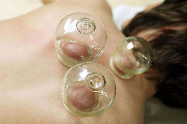 拔火罐會引起月經(jīng)推遲嗎 拔火罐會影響月經(jīng)嗎 拔火罐會引起月經(jīng)推遲嗎 拔火罐會影響月經(jīng)嗎