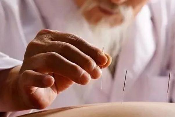 針灸對神經損傷恢復有作用嗎 針灸對耳鳴治耳鳴有效果嗎