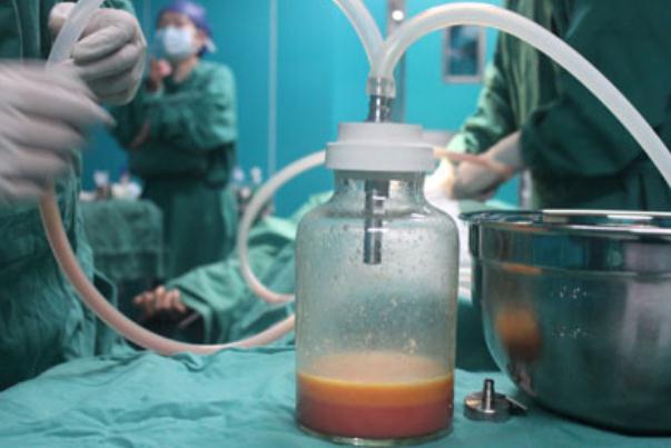 抽脂肪的后遺癥 抽脂肪是怎么抽出來的 抽脂肪的后遺癥 抽脂肪是怎么抽出來的