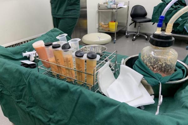 抽脂肪的后遺癥 抽脂肪是怎么抽出來的 抽脂肪的后遺癥 抽脂肪是怎么抽出來的