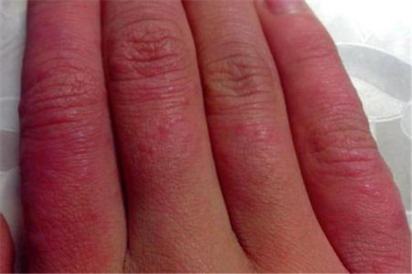 凍瘡發(fā)癢是什么階段 凍瘡發(fā)癢怎么辦 凍瘡發(fā)癢是什么階段 凍瘡發(fā)癢怎么辦