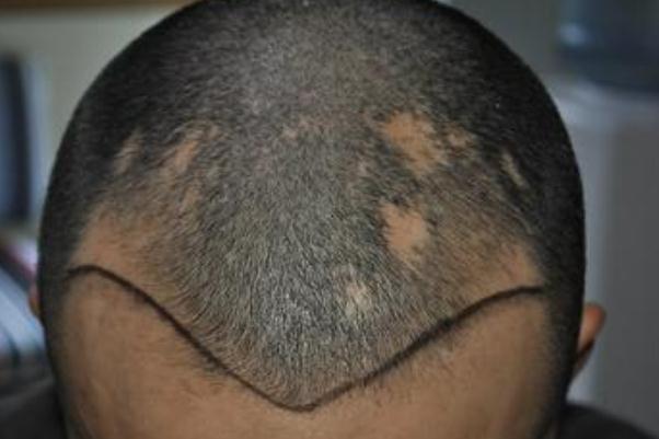 植發(fā)是永久性的嗎 植發(fā)是拆東墻補西墻嗎 植發(fā)是永久性的嗎 植發(fā)是拆東墻補西墻嗎