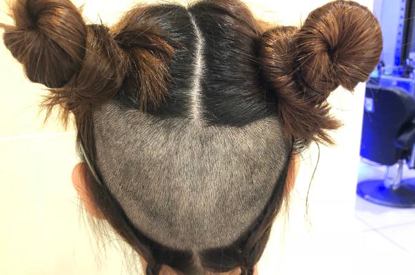 植發(fā)是永久性的嗎 植發(fā)是拆東墻補西墻嗎 植發(fā)是永久性的嗎 植發(fā)是拆東墻補西墻嗎