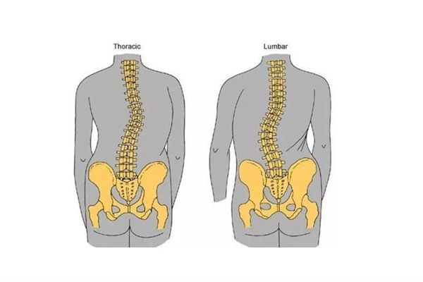 骨盆前傾可以通過正骨恢復嗎 骨盆前傾去哪里矯正 骨盆前傾可以通過正骨恢復嗎 骨盆前傾去哪里矯正