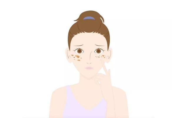 曬斑是什么樣子的 曬斑是因?yàn)榉罆駴]做好嗎
