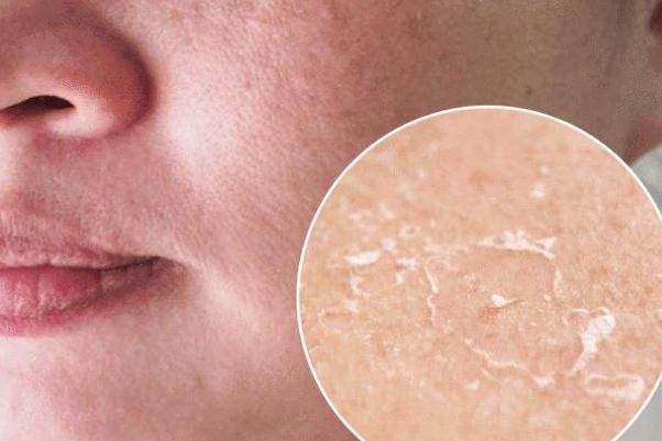 皮膚干燥脫皮嚴(yán)重像魚(yú)鱗怎么辦 皮膚干燥起皮像魚(yú)鱗是怎么回事 皮膚干燥脫皮嚴(yán)重像魚(yú)鱗怎么辦 皮膚干燥起皮像魚(yú)鱗是怎么回事