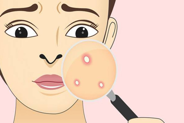 痘痘長到多少歲 長痘需要注意些什么 痘痘長到多少歲 長痘需要注意些什么