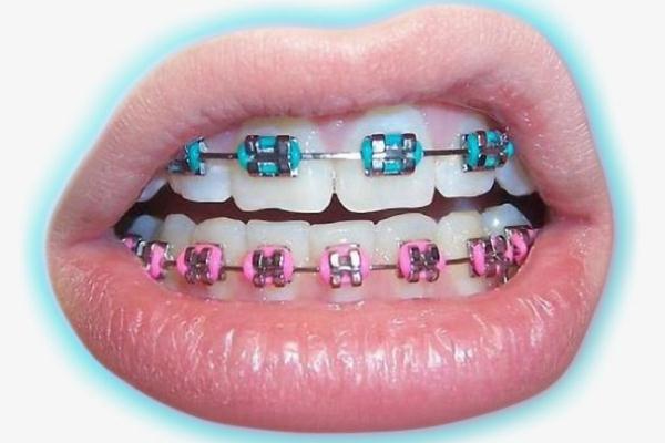 牙套是上下牙一起戴嗎 牙套是怎么矯正牙齒的 牙套是上下牙一起戴嗎 牙套是怎么矯正牙齒的