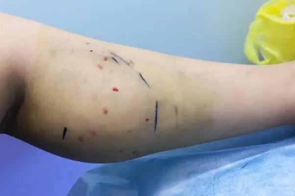 瘦腿針對脂肪腿有效果嗎 瘦腿針對身體有傷害嗎 瘦腿針對脂肪腿有效果嗎 瘦腿針對身體有傷害嗎
