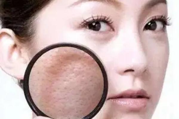 毛孔粗大有痘坑怎么修復(fù) 毛孔粗大有幾種類(lèi)型