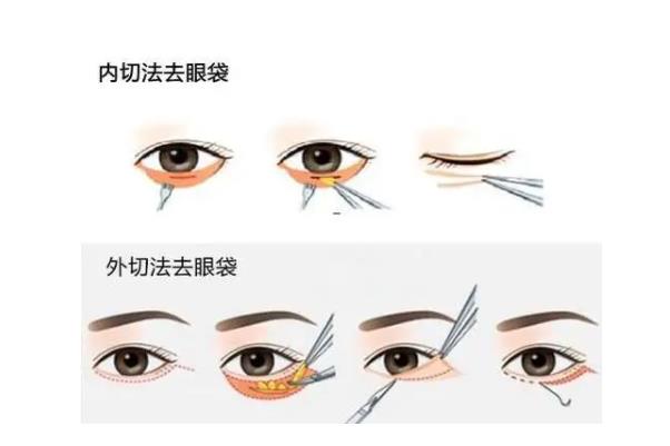 去眼袋手術(shù)費用大概多少錢 去眼袋手術(shù)有危害嗎 去眼袋手術(shù)費用大概多少錢 去眼袋手術(shù)有危害嗎