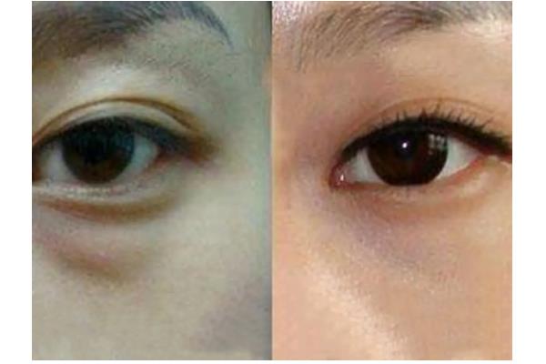 去眼袋手術(shù)費用大概多少錢 去眼袋手術(shù)有危害嗎 去眼袋手術(shù)費用大概多少錢 去眼袋手術(shù)有危害嗎