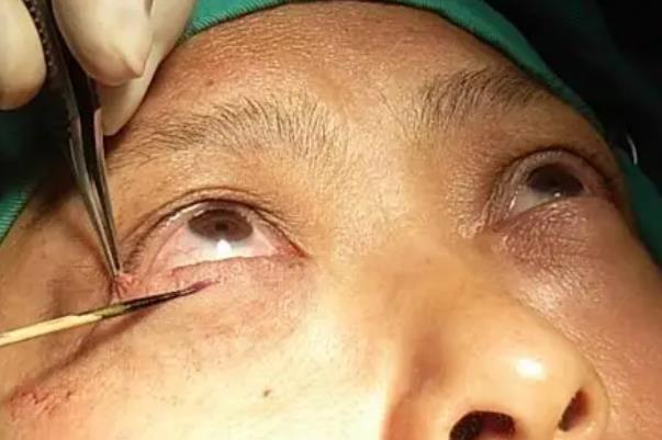 去眼袋手術(shù)費用大概多少錢 去眼袋手術(shù)有危害嗎 去眼袋手術(shù)費用大概多少錢 去眼袋手術(shù)有危害嗎