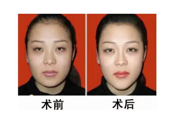 墊下巴要全麻嗎 墊下巴有幾種方法 墊下巴要全麻嗎 墊下巴有幾種方法