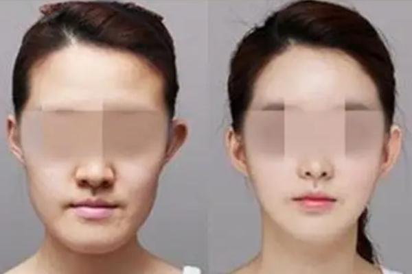 墊下巴要全麻嗎 墊下巴有幾種方法 墊下巴要全麻嗎 墊下巴有幾種方法