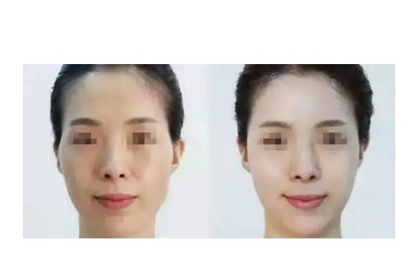 童顏針會凹凸不平嗎 童顏針對身體有害嗎 童顏針會凹凸不平嗎 童顏針對身體有害嗎