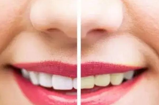 冷光美白牙齒會很白嗎 冷光美白牙齒對四環(huán)素牙有用嗎 冷光美白牙齒會很白嗎 冷光美白牙齒對四環(huán)素牙有用嗎