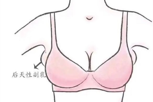 副乳切除手術(shù)是全麻還是局麻 副乳切除手術(shù)后多久可以正常活動(dòng)