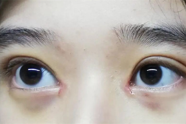 武漢開(kāi)眼角最好的醫(yī)院 武漢開(kāi)眼角手術(shù)一般需要多少錢