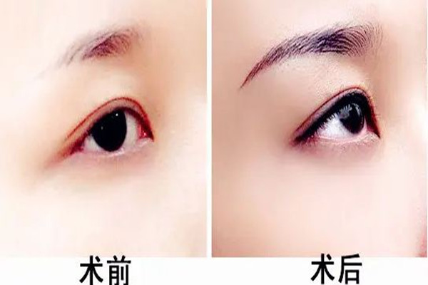 武漢提眉手術(shù)哪個(gè)醫(yī)院做的好 武漢提眉手術(shù)需要多少錢(qián)