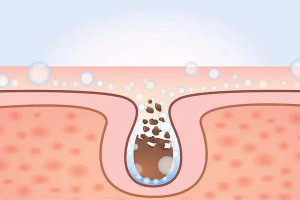 中南路MY科技纖體美膚連鎖店清潔毛孔后皮膚感覺怎么樣 清潔毛孔會不會長痘 中南路MY科技纖體美膚連鎖店清潔毛孔后皮膚感覺怎么樣 清潔毛孔會不會長痘