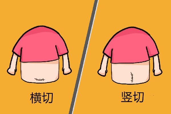 官方回應男子大罵剖腹產(chǎn)妻子 剖腹產(chǎn)之后要注意什么